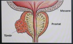 Prostat kanseri nedir, sebepleri nelerdir?