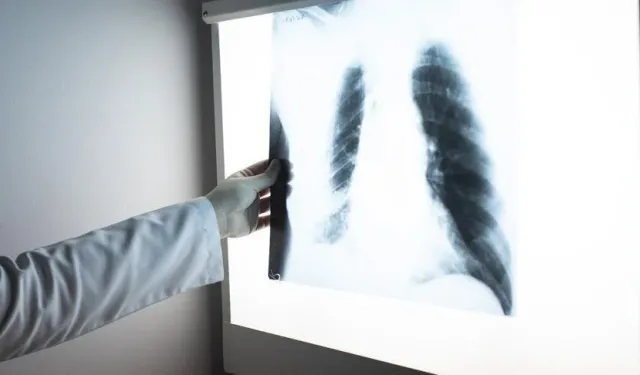 Dünyada Kanser Vakaları: Erkeklerde Akciğer, Kadınlarda Meme Kanseri Başı Çekiyor